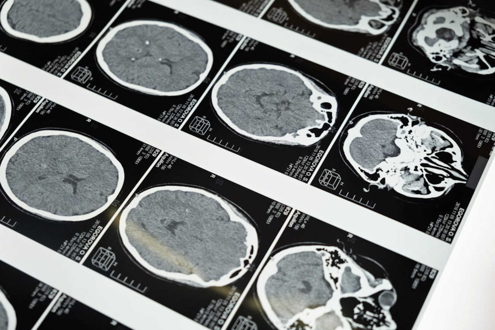 Avance: chip cerebral para devolver el habla